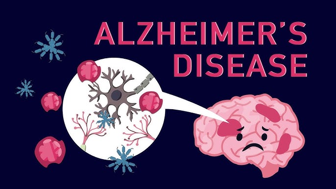 Alzheimer facts